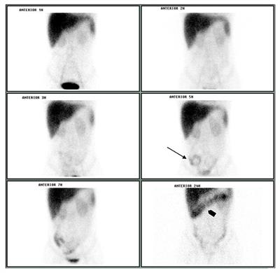 Herpes simplex Virus Pneumonitis in an Acute/Subacute Paracoccidioidomycosis Patient With Malabsorption Syndrome. Case-Report and Literature Review